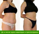 Кавитация 40K MINI 